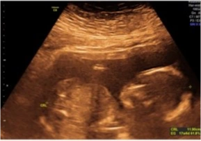 Ecografía segundo trimestre, Eco de embarazo, eco control de peso, ecografía de revelación de sexo, eco para saber si es niño o niña