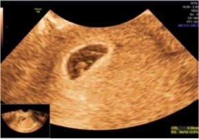 Ecografía confirmación de embarazo, ecografía transvaginal obstétrica, ecografía obstétrica primer trimestre, eco tv